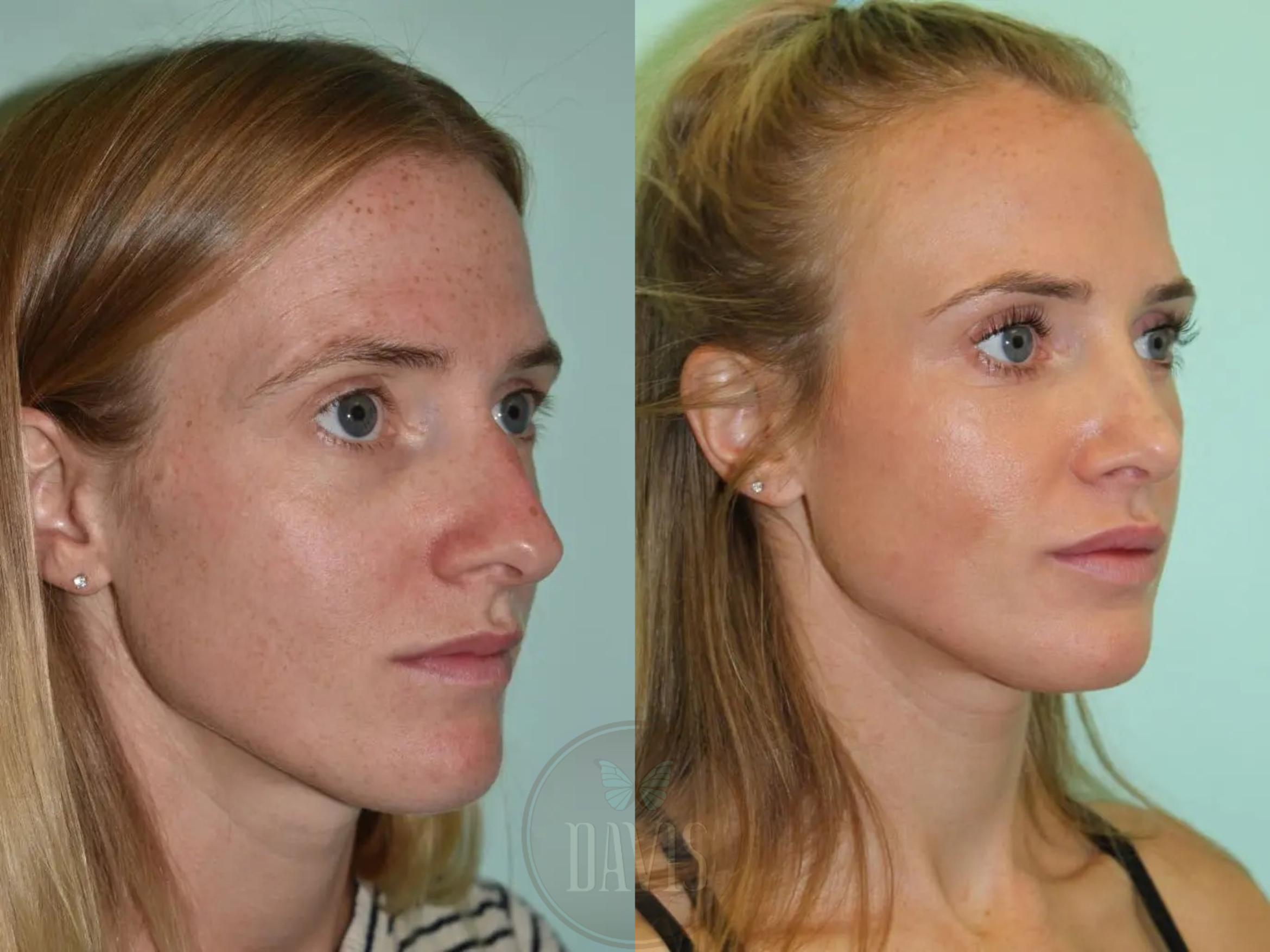 Before & After Female Rhinoplasty Case 1102 View 6 View in Tampa, FL