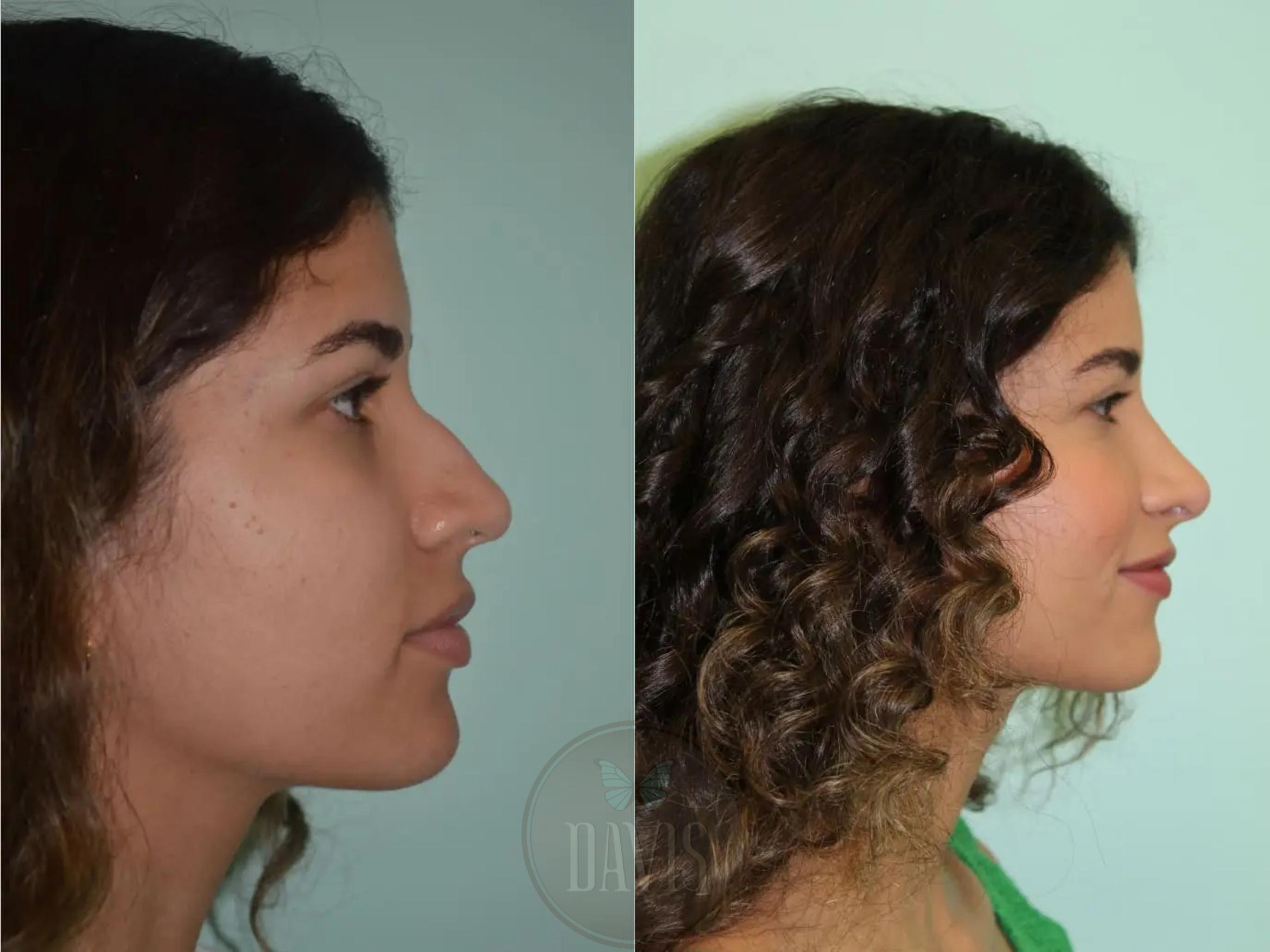 Before & After Female Rhinoplasty Case 1102 View 7 View in Tampa, FL