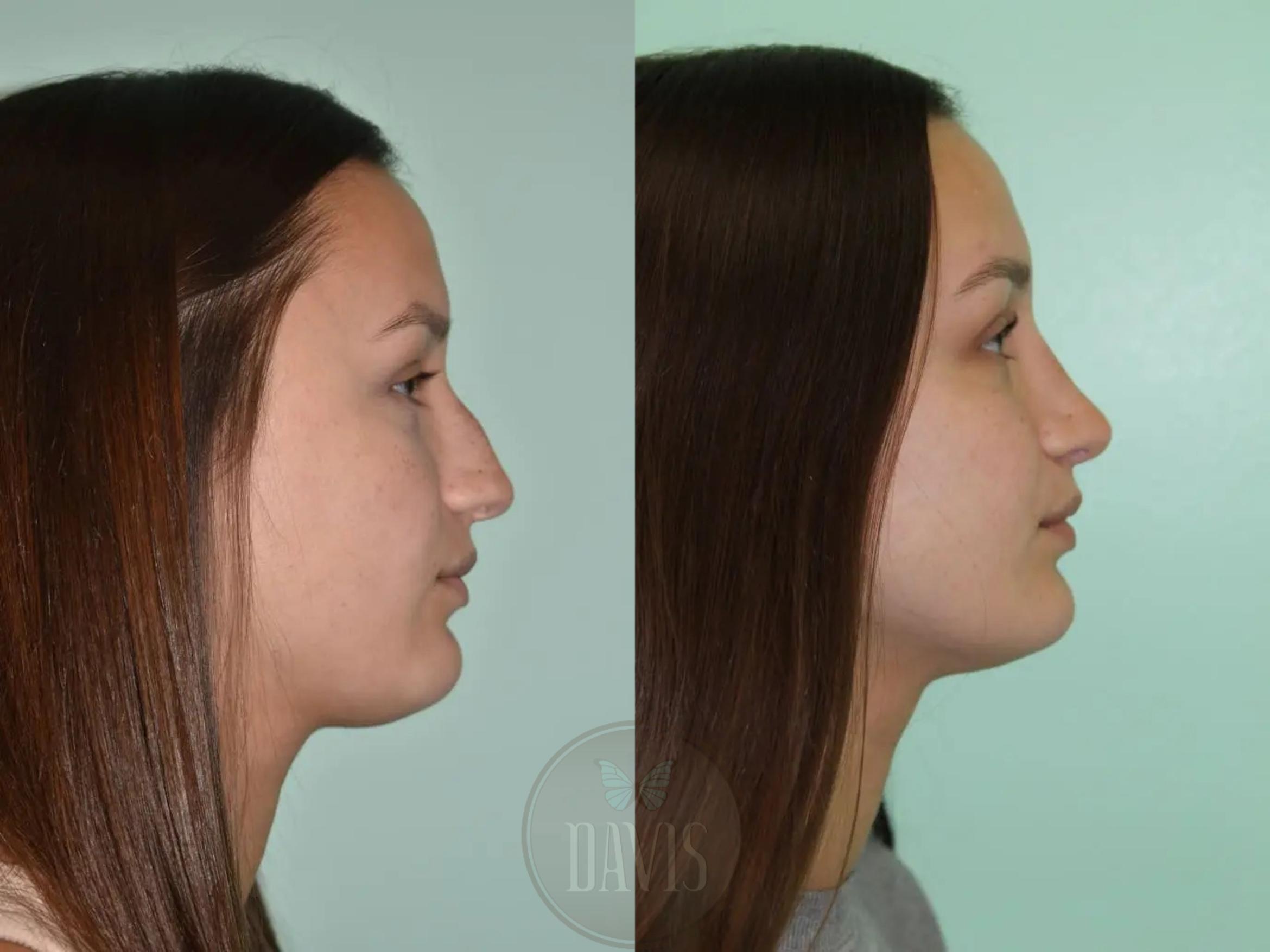 Before & After Female Rhinoplasty Case 1102 View 9 View in Tampa, FL