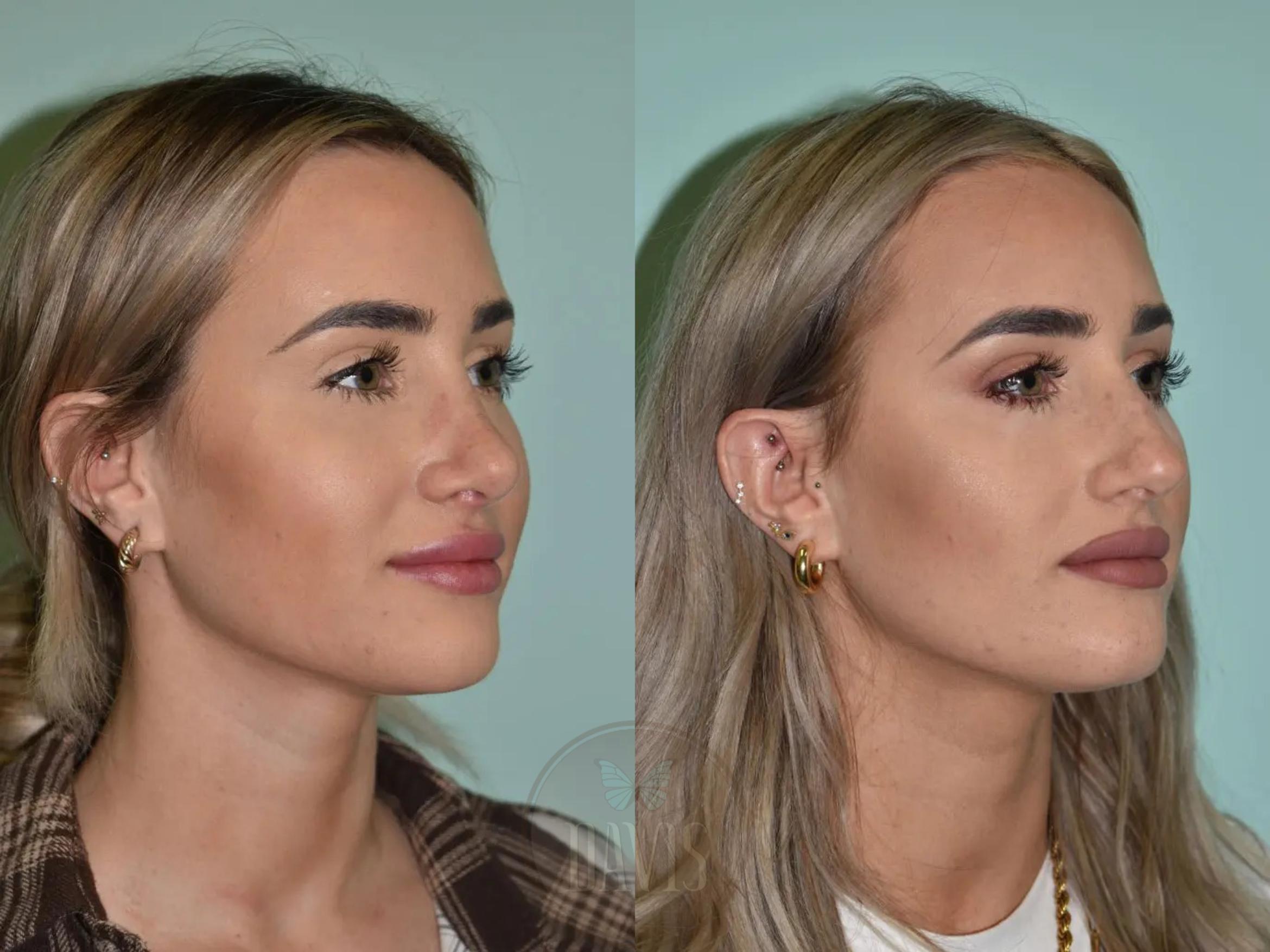 Before & After Female Rhinoplasty Case 1103 View 1 View in Tampa, FL