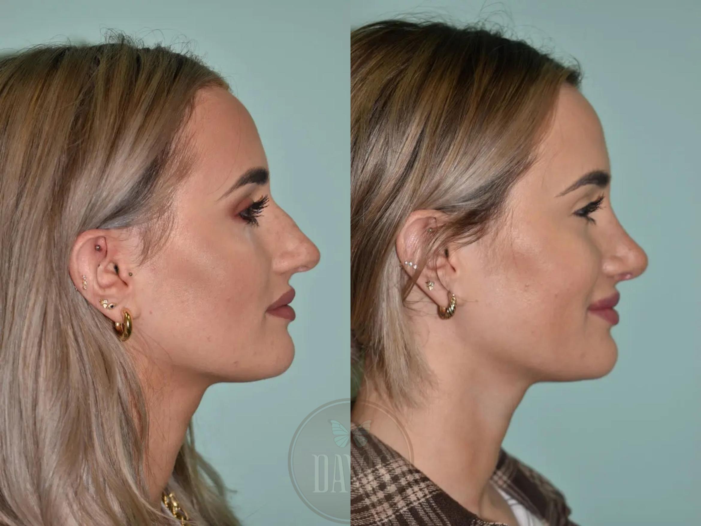 Before & After Female Rhinoplasty Case 1103 View 2 View in Tampa, FL