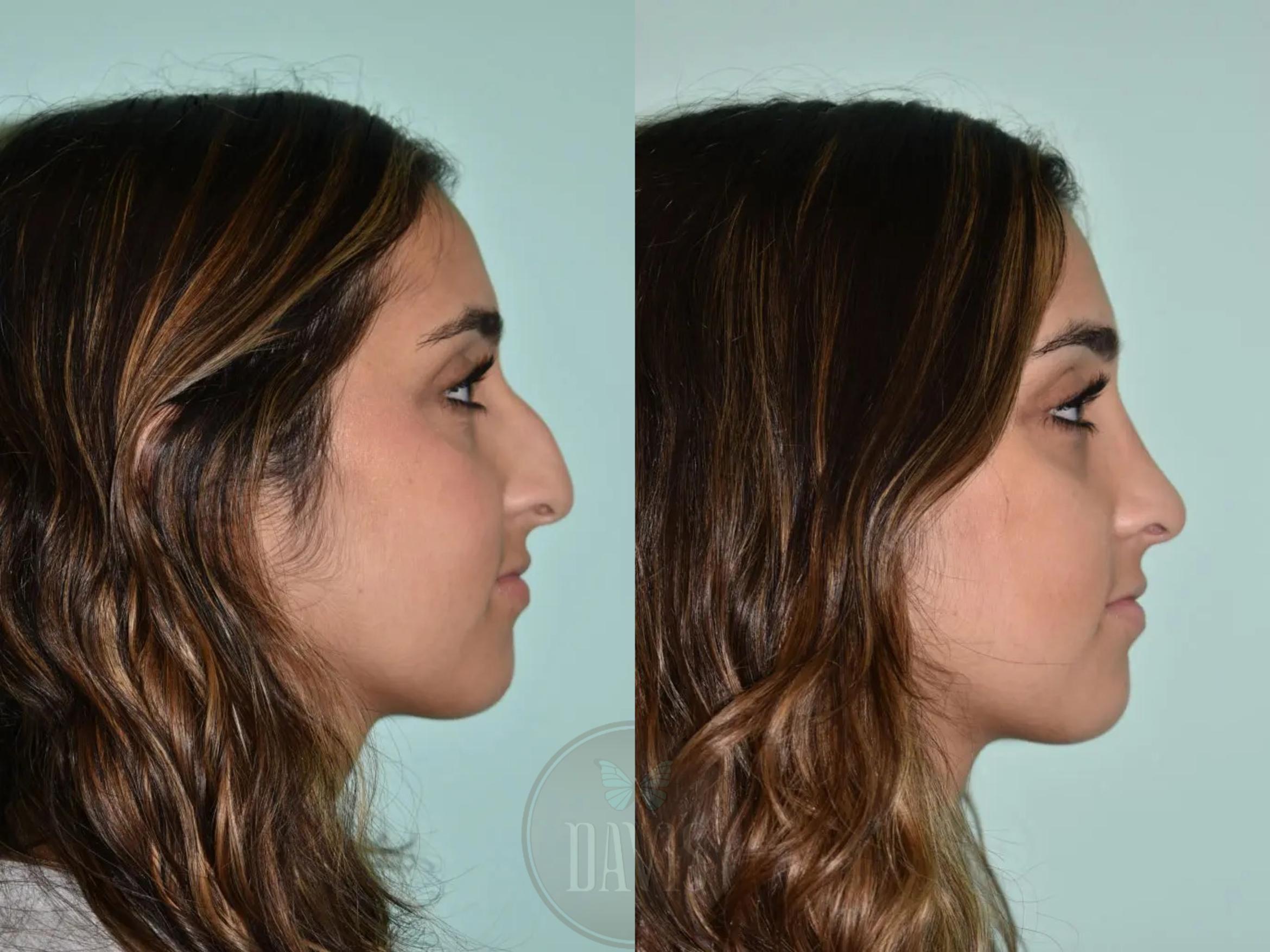 Before & After Female Rhinoplasty Case 1104 View 1 View in Tampa, FL