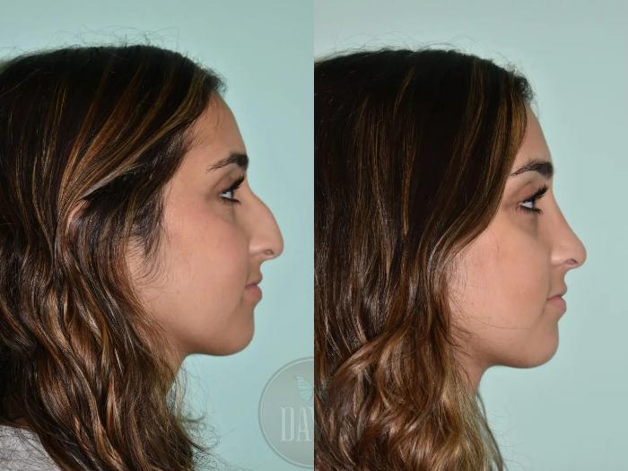 Before & After Female Rhinoplasty Case 1104 View 1 View in Tampa, FL