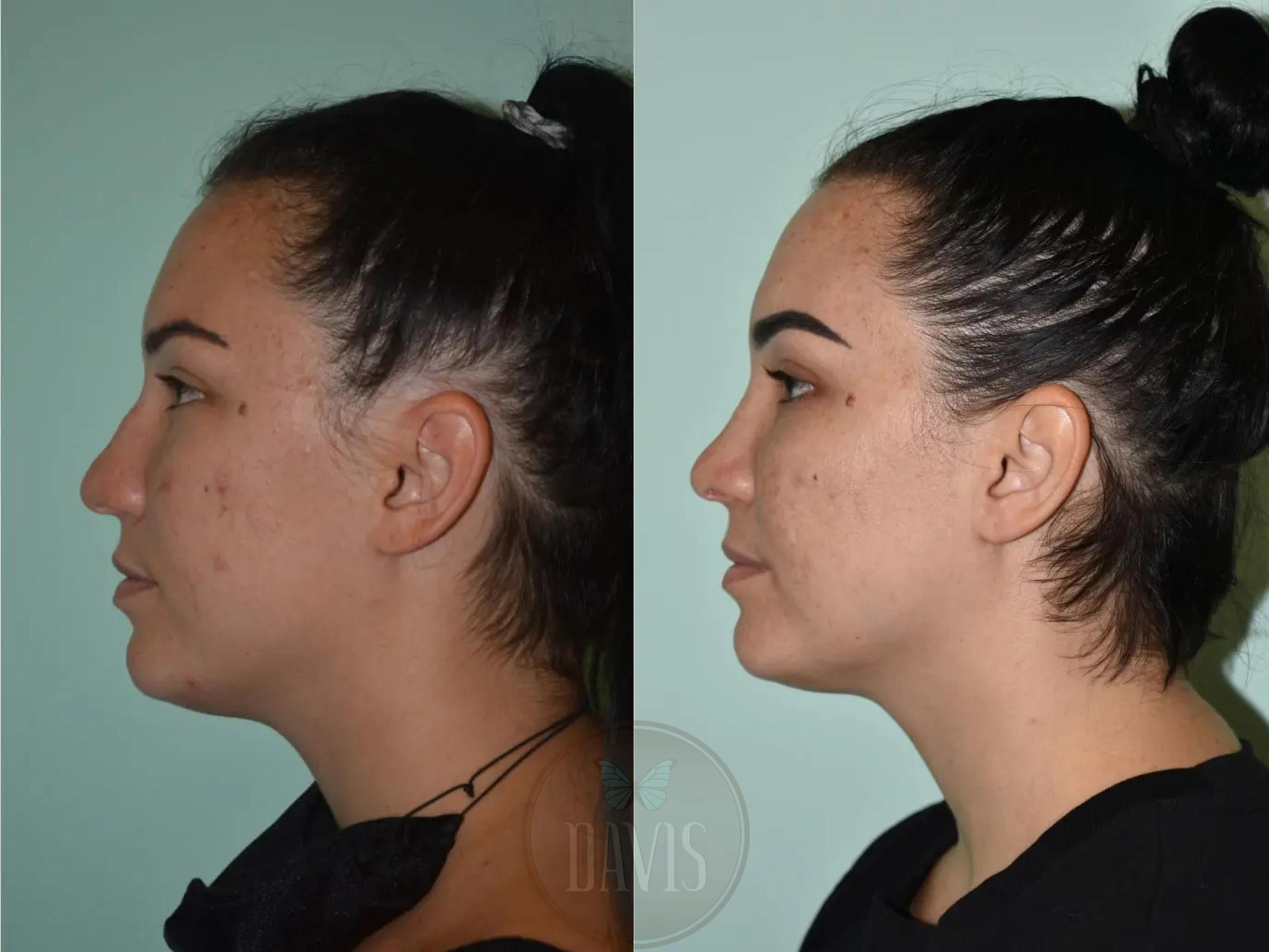 Female Rhinoplasty in Tampa, FL - Davis Facial Plastic Surgery