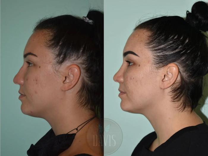 Before & After Female Rhinoplasty Case 1105 View 1 View in Tampa, FL