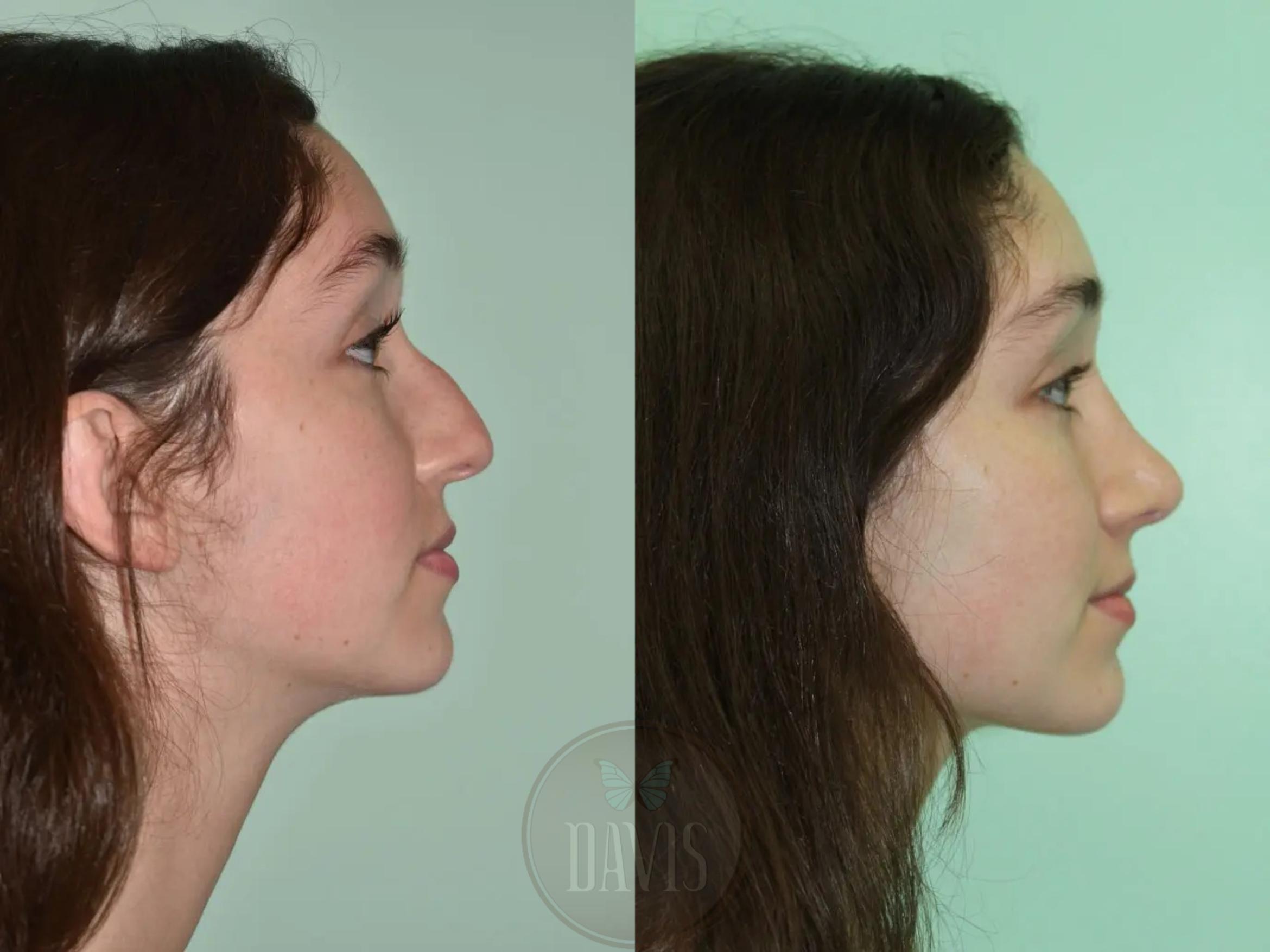 Before & After Female Rhinoplasty Case 1106 View 1 View in Tampa, FL