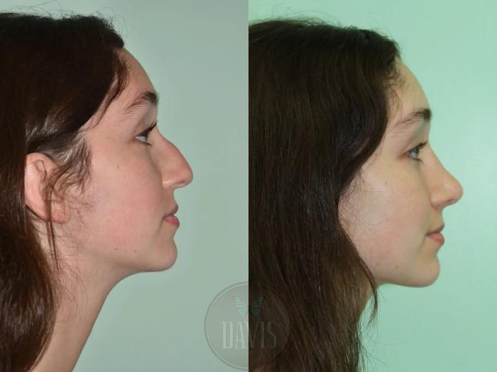 Before & After Female Rhinoplasty Case 1106 View 1 View in Tampa, FL