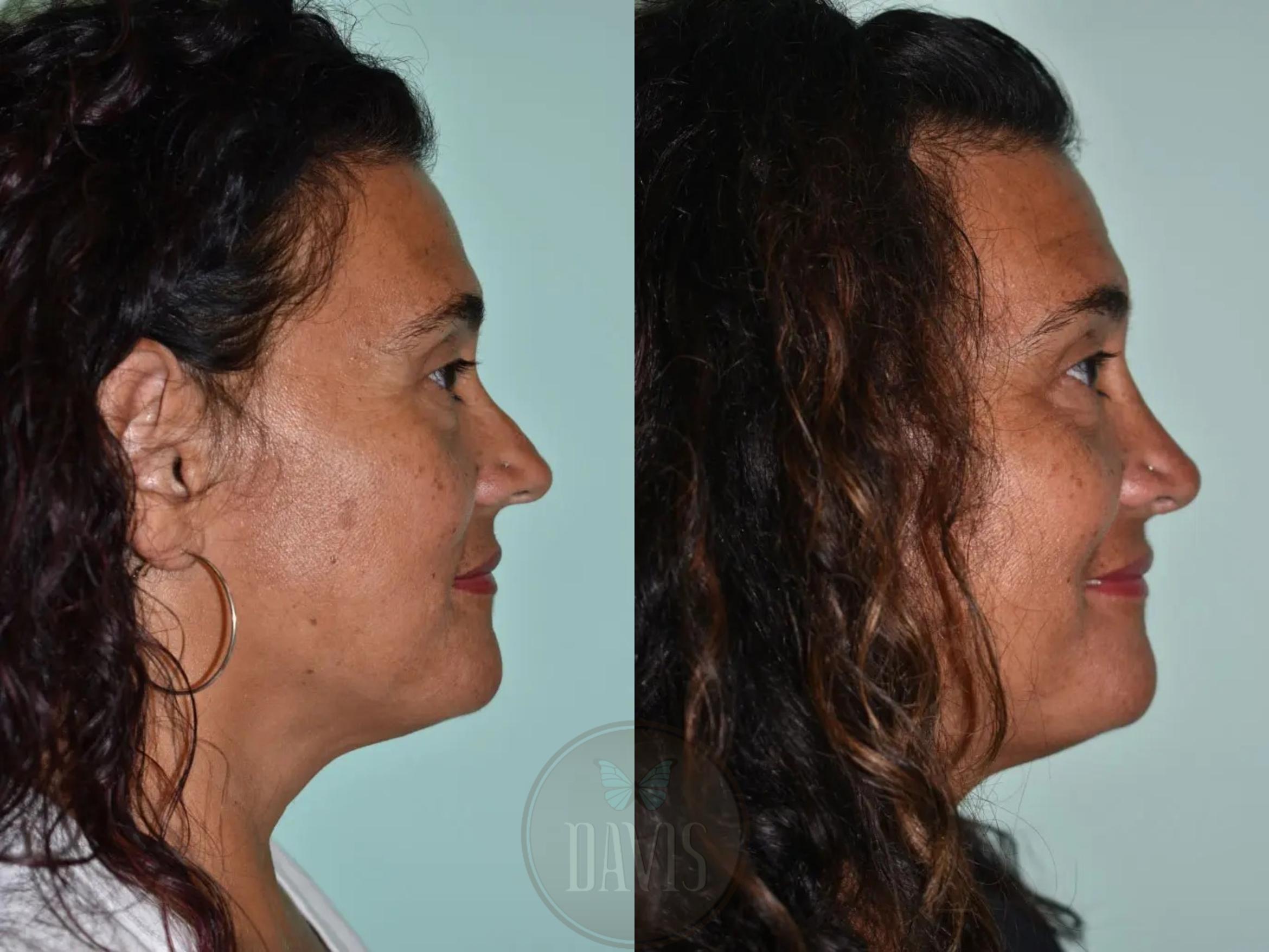 Before & After Female Rhinoplasty Case 1107 View 1 View in Tampa, FL