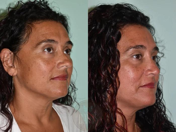 Before & After Female Rhinoplasty Case 1107 View 2 View in Tampa, FL