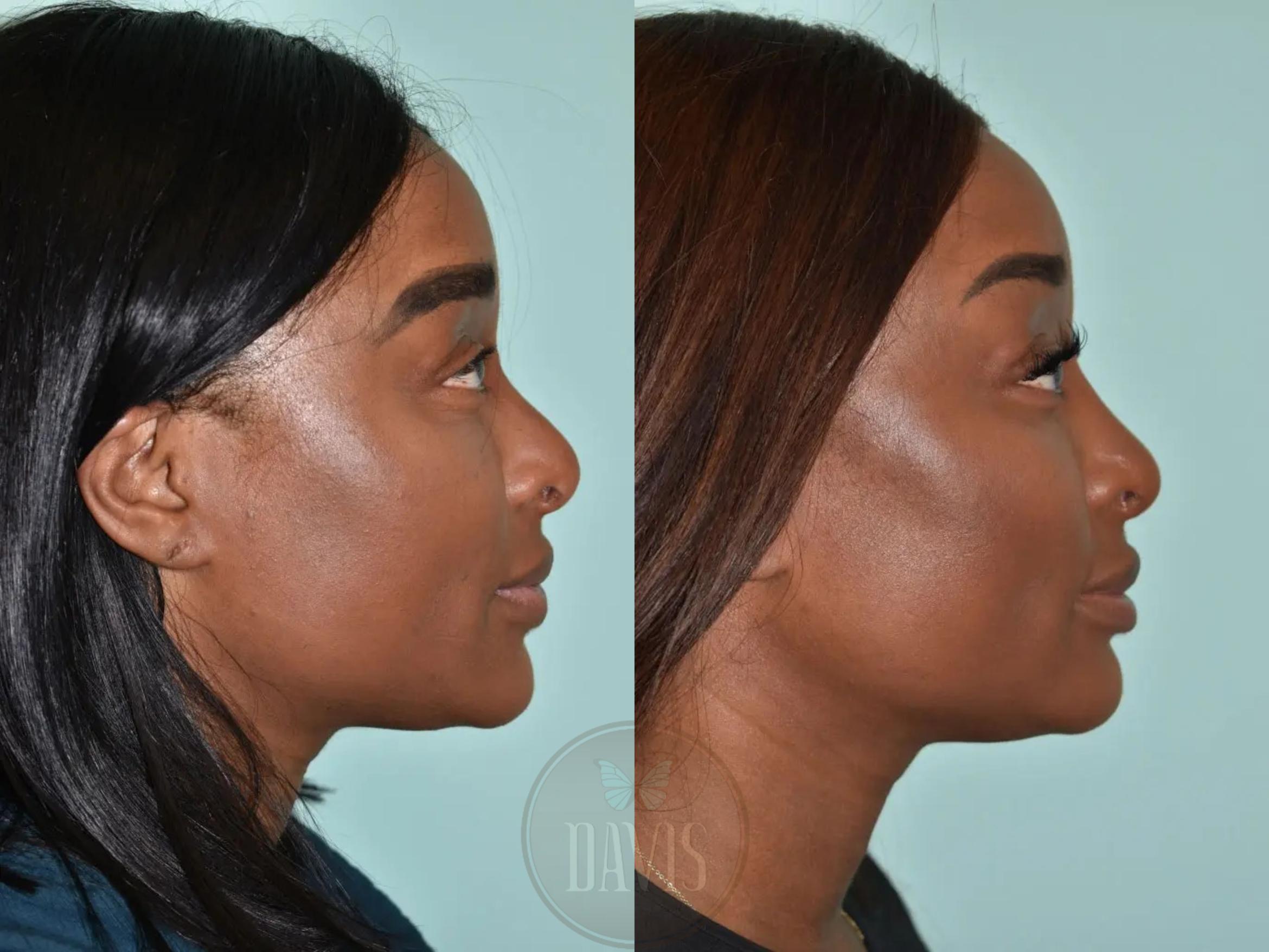 Before & After Female Rhinoplasty Case 1108 View 1 View in Tampa, FL