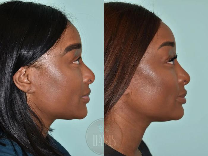Before & After Female Rhinoplasty Case 1108 View 1 View in Tampa, FL