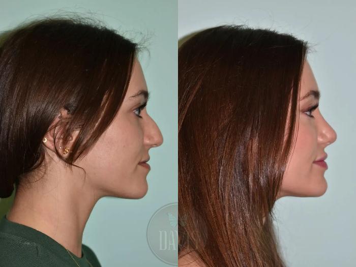 Before & After Female Rhinoplasty Case 1109 View 1 View in Tampa, FL