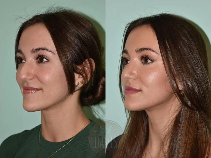 Before & After Female Rhinoplasty Case 1109 View 2 View in Tampa, FL