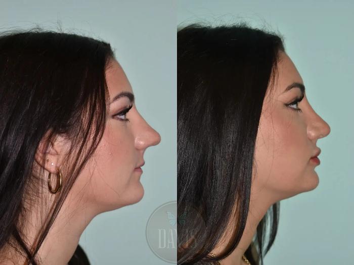 Before & After Female Rhinoplasty Case 1110 View 1 View in Tampa, FL