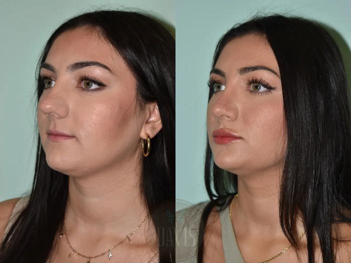 Before & After Female Rhinoplasty Case 1110 View 2 View in Tampa, FL