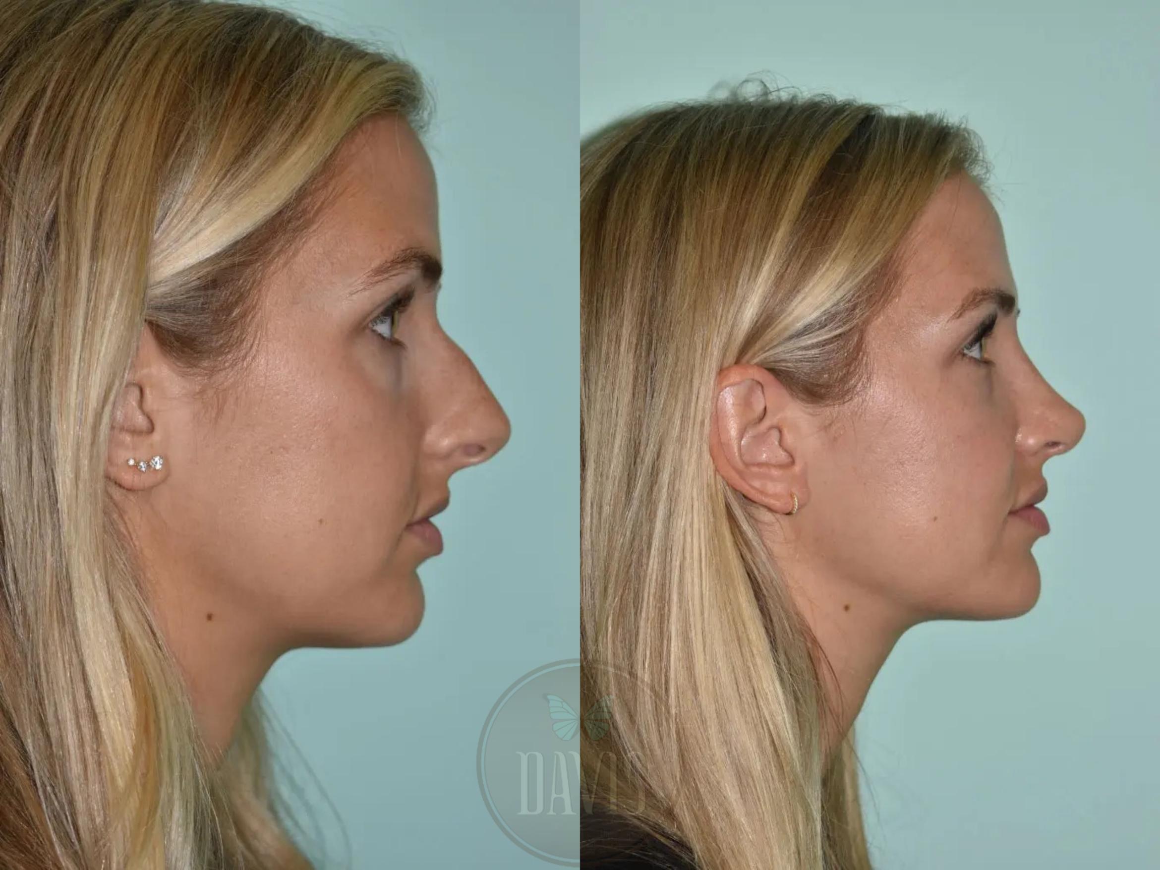 Before & After Female Rhinoplasty Case 1111 View 1 View in Tampa, FL