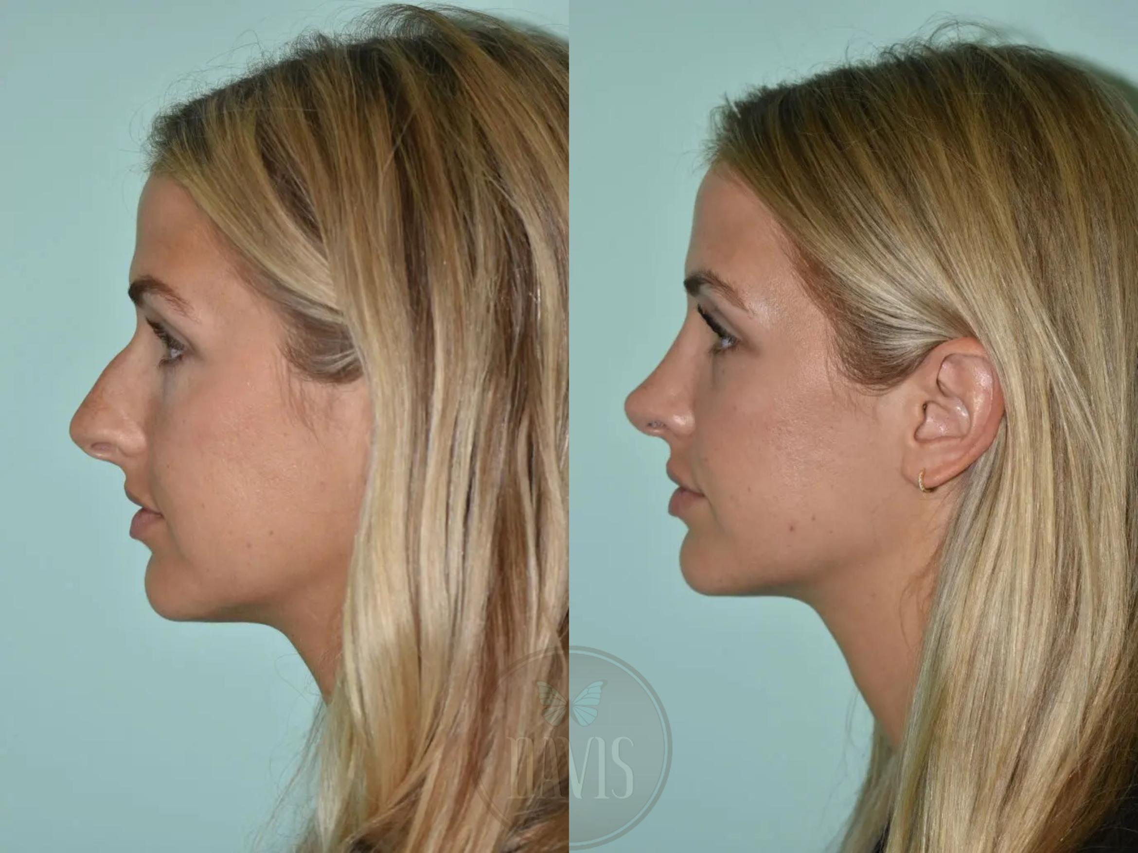 Before & After Female Rhinoplasty Case 1111 View 2 View in Tampa, FL