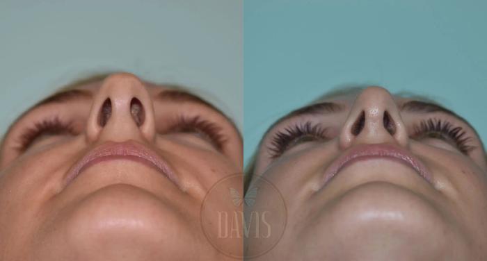 Before & After Female Rhinoplasty Case 1111 View 3 View in Tampa, FL