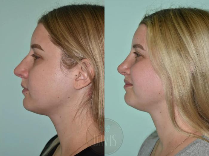 Before & After Female Rhinoplasty Case 1112 View 1 View in Tampa, FL