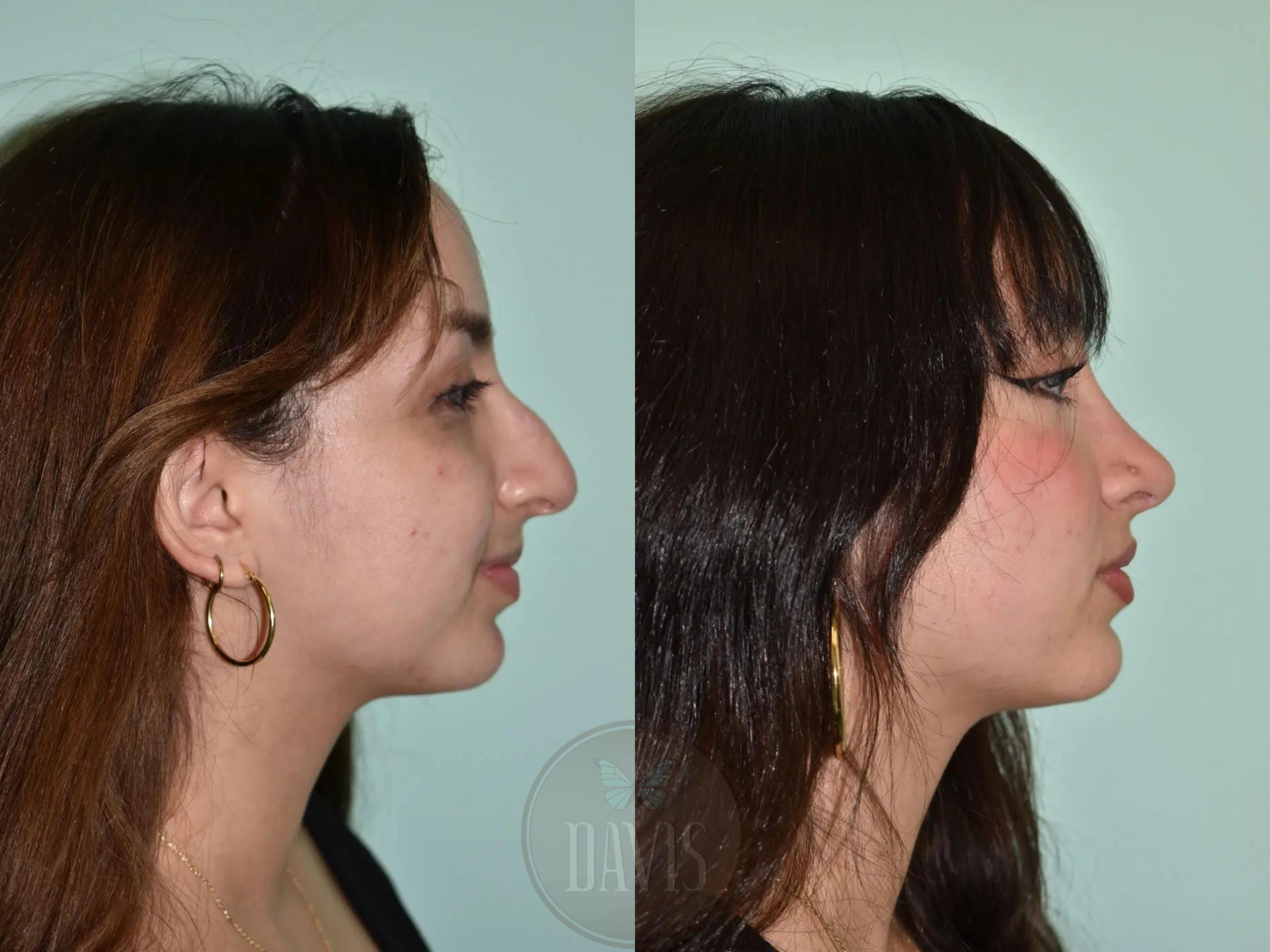 Before & After Female Rhinoplasty Case 1113 View 1 View in Tampa, FL