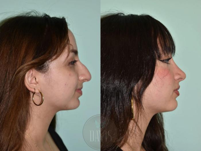 Before & After Female Rhinoplasty Case 1113 View 1 View in Tampa, FL