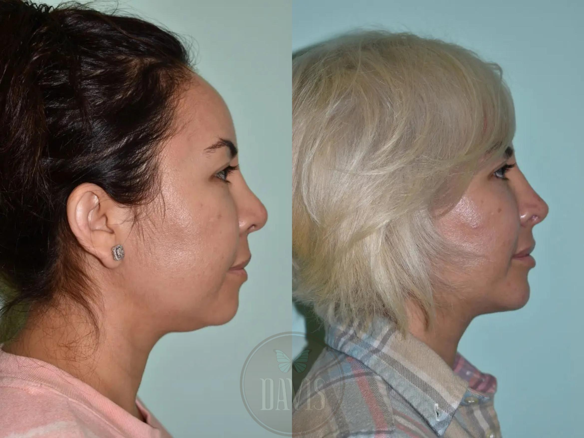 Before & After Female Rhinoplasty Case 1114 View 1 View in Tampa, FL