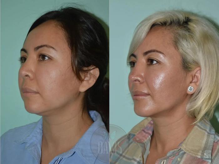 Before & After Female Rhinoplasty Case 1114 View 2 View in Tampa, FL