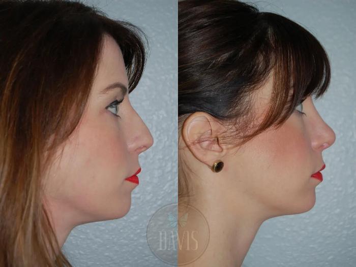 Before & After Female Rhinoplasty Case 1115 View 1 View in Tampa, FL