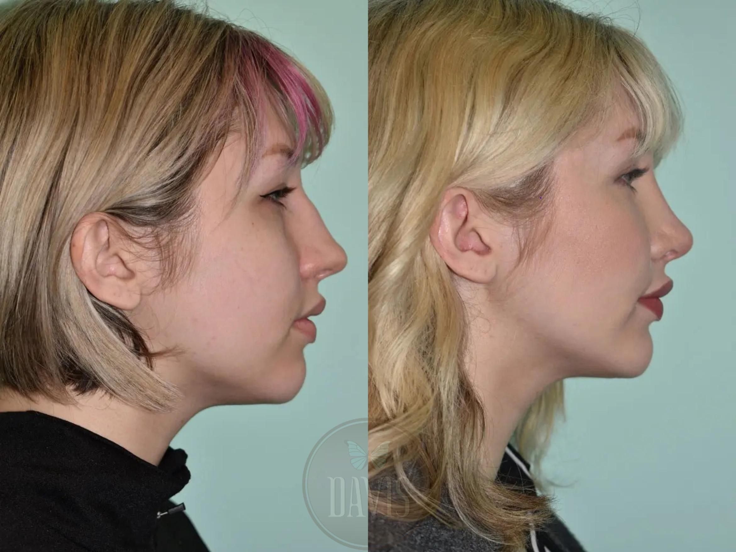 Before & After Female Rhinoplasty Case 1116 View 1 View in Tampa, FL
