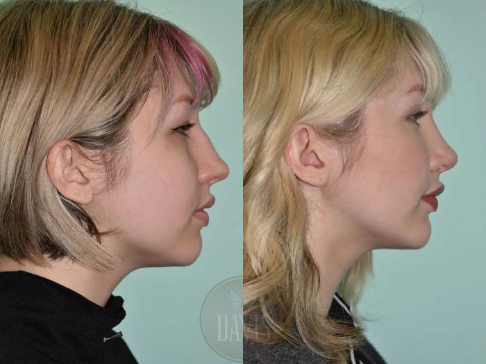 Before & After Female Rhinoplasty Case 1116 View 1 View in Tampa, FL