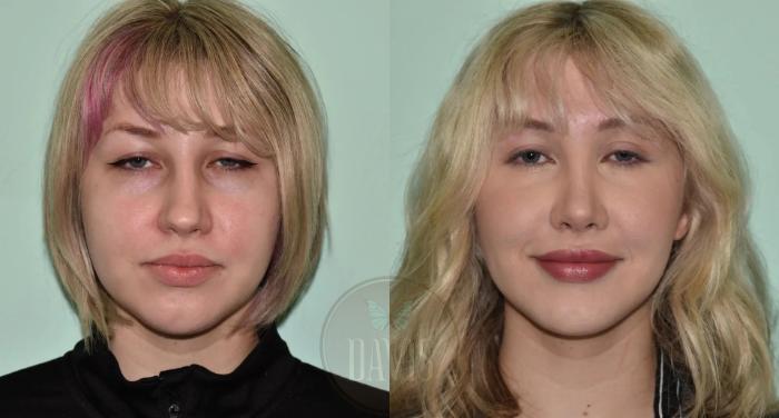 Before & After Female Rhinoplasty Case 1116 View 2 View in Tampa, FL