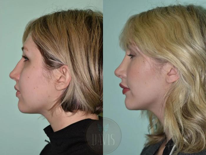 Before & After Female Rhinoplasty Case 1116 View 3 View in Tampa, FL