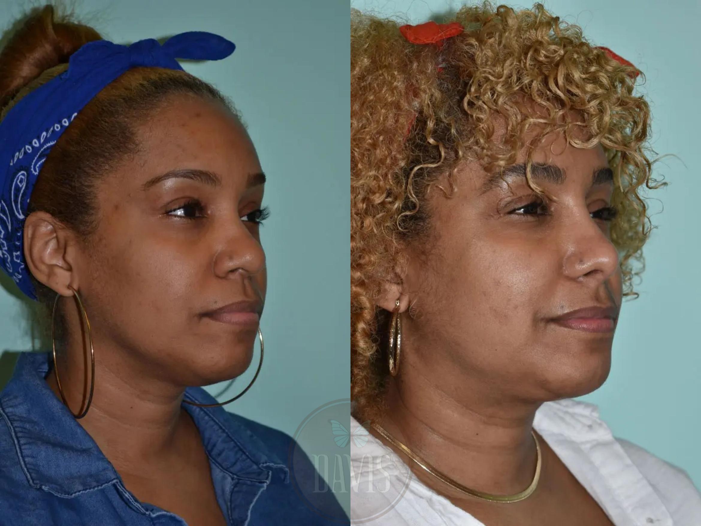 Before & After Female Rhinoplasty Case 1117 View 1 View in Tampa, FL