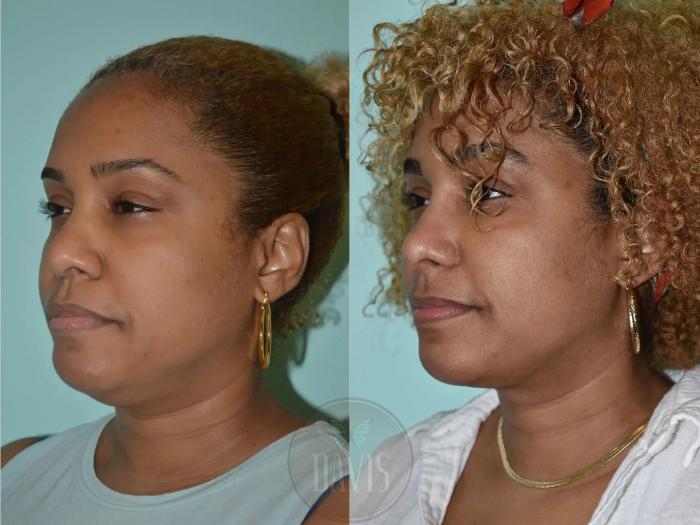 Before & After Female Rhinoplasty Case 1117 View 2 View in Tampa, FL