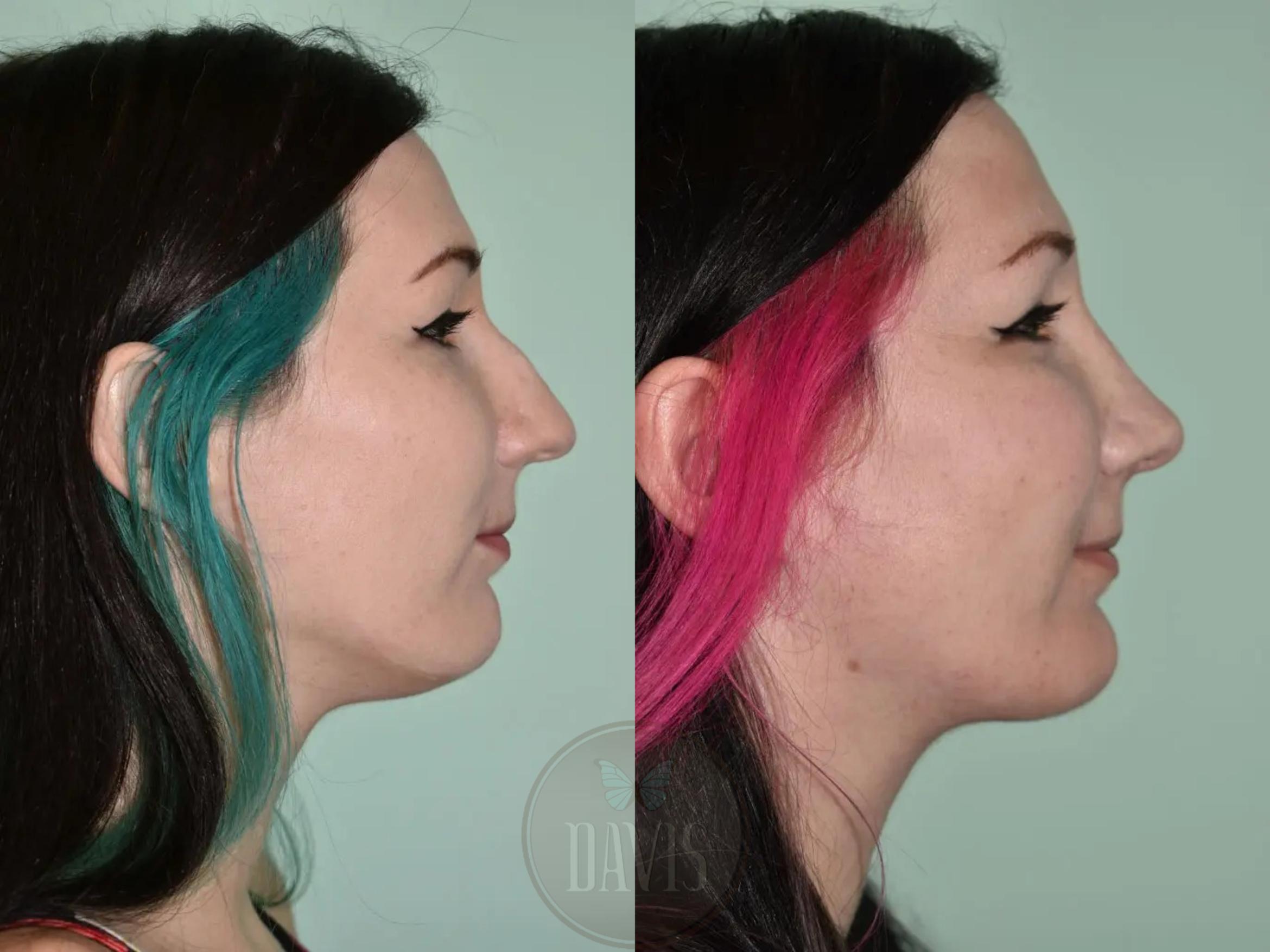 Before & After Female Rhinoplasty Case 1118 View 1 View in Tampa, FL