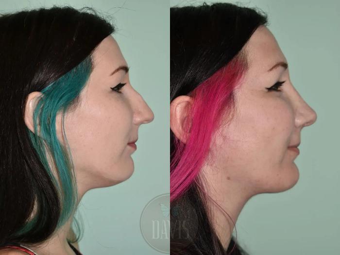 Before & After Female Rhinoplasty Case 1118 View 1 View in Tampa, FL