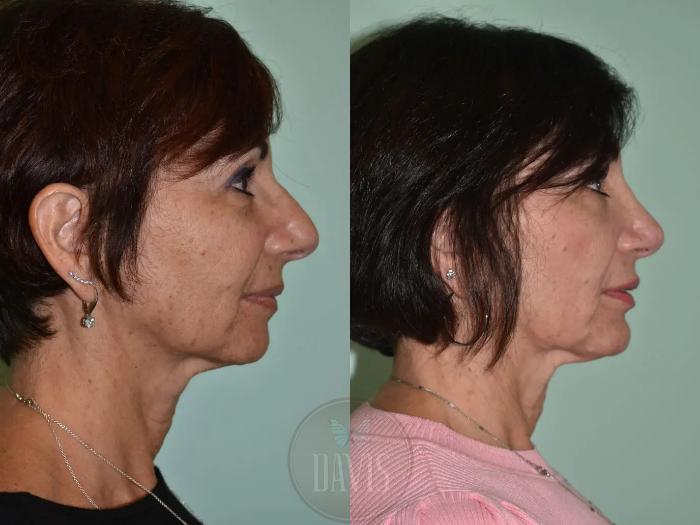 Before & After Female Rhinoplasty Case 1119 View 1 View in Tampa, FL