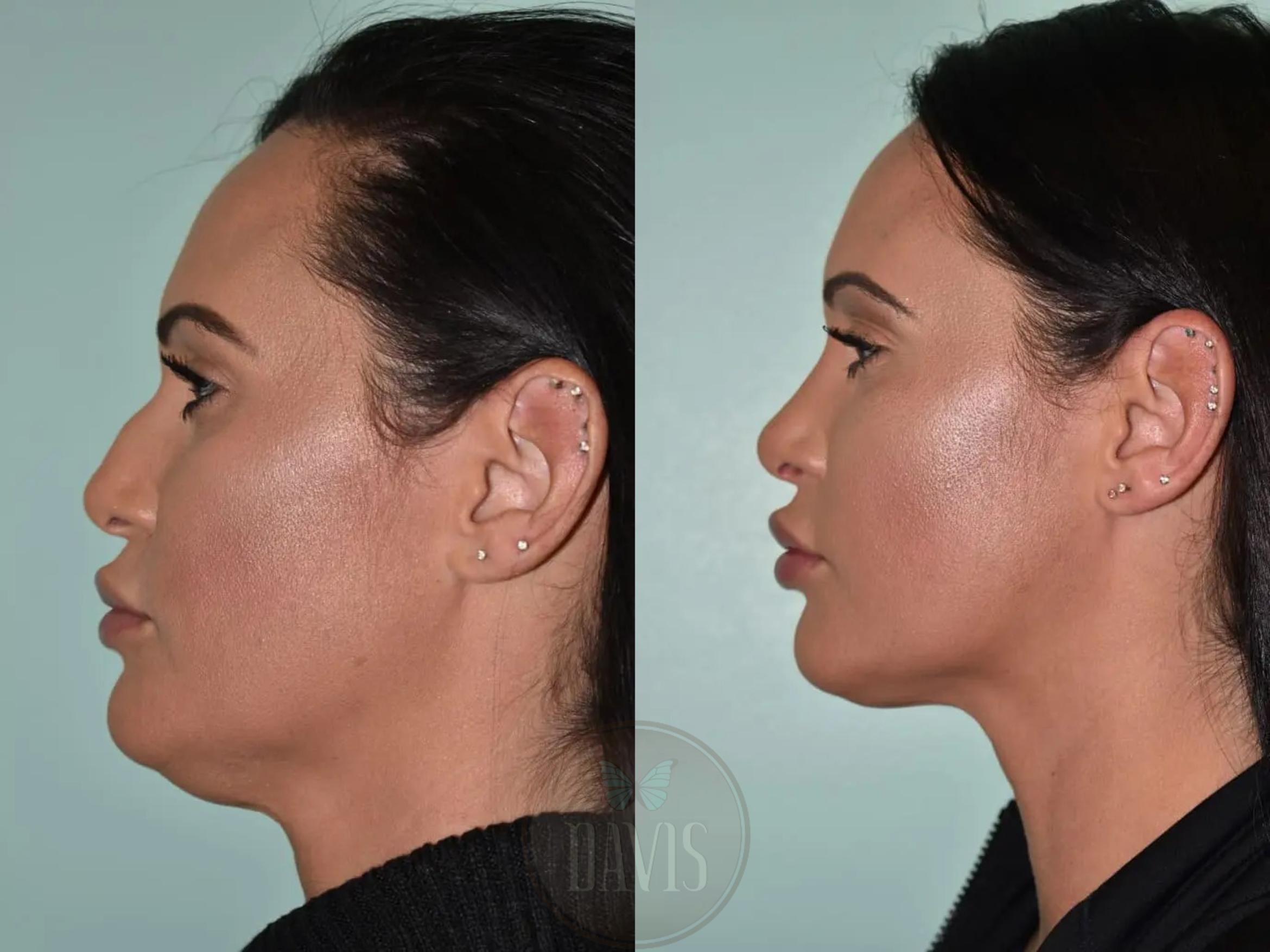 Before & After Female Rhinoplasty Case 1120 View 1 View in Tampa, FL