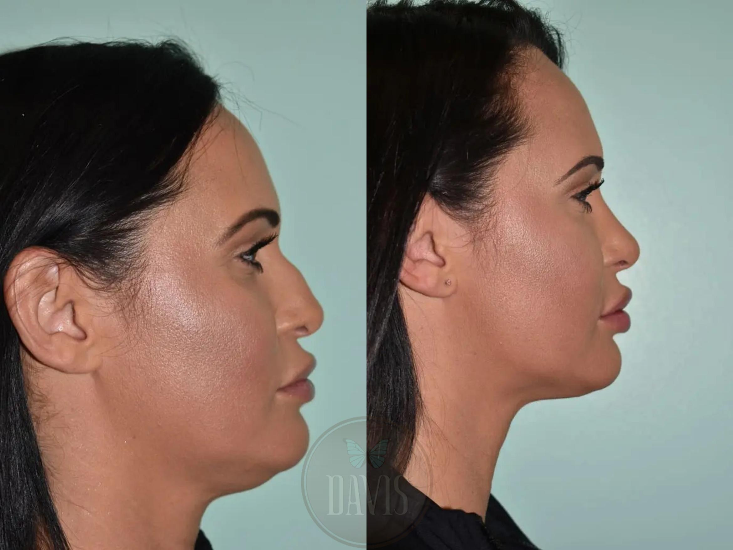 Before & After Female Rhinoplasty Case 1120 View 2 View in Tampa, FL