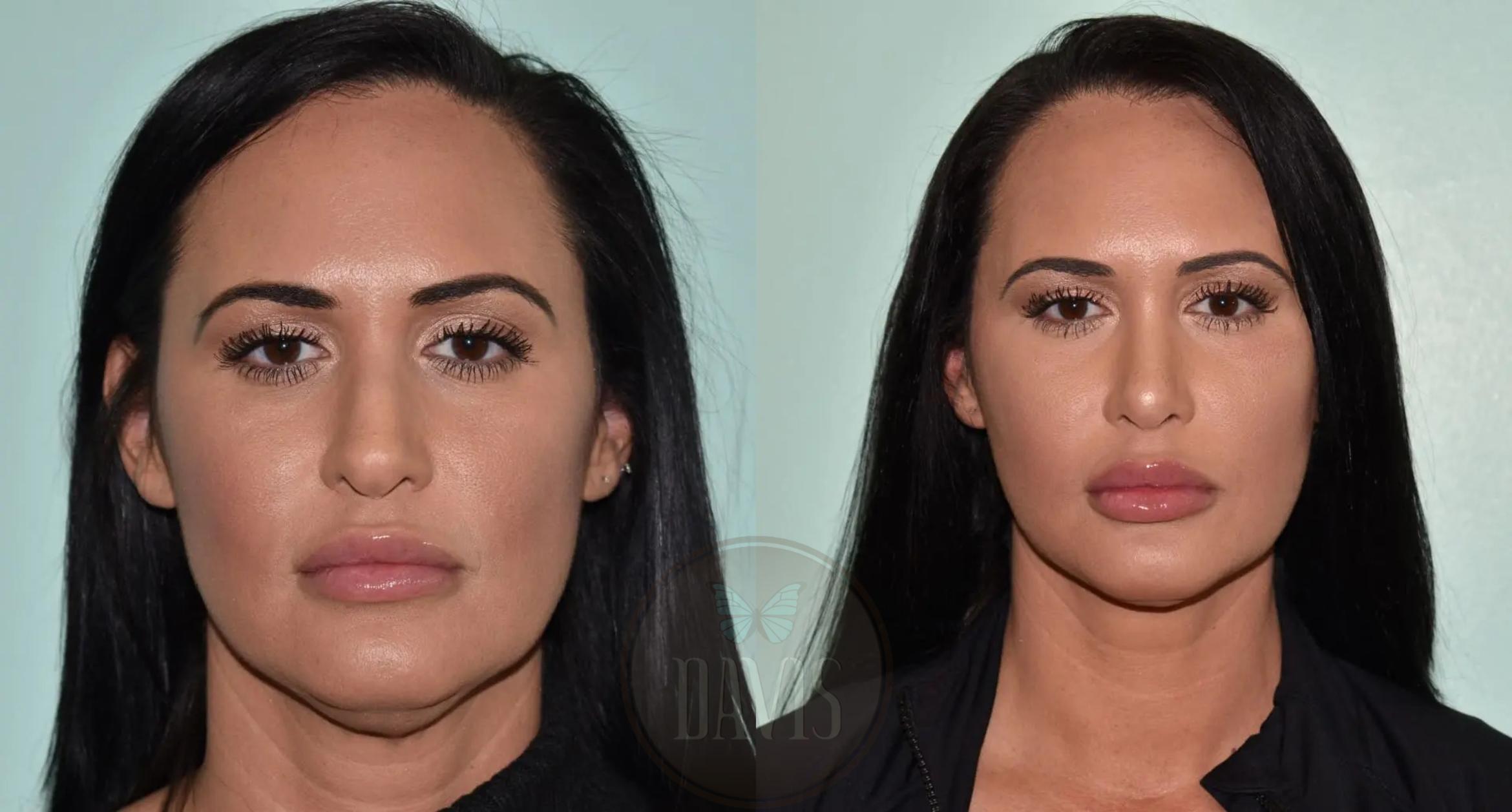 Before & After Female Rhinoplasty Case 1120 View 3 View in Tampa, FL