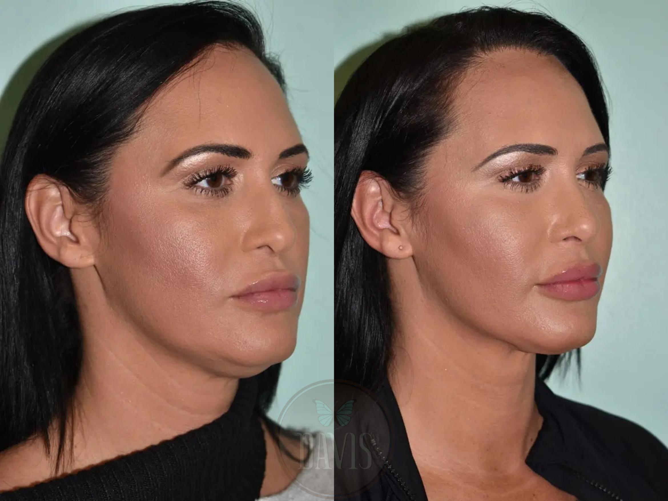 Before & After Female Rhinoplasty Case 1120 View 4 View in Tampa, FL
