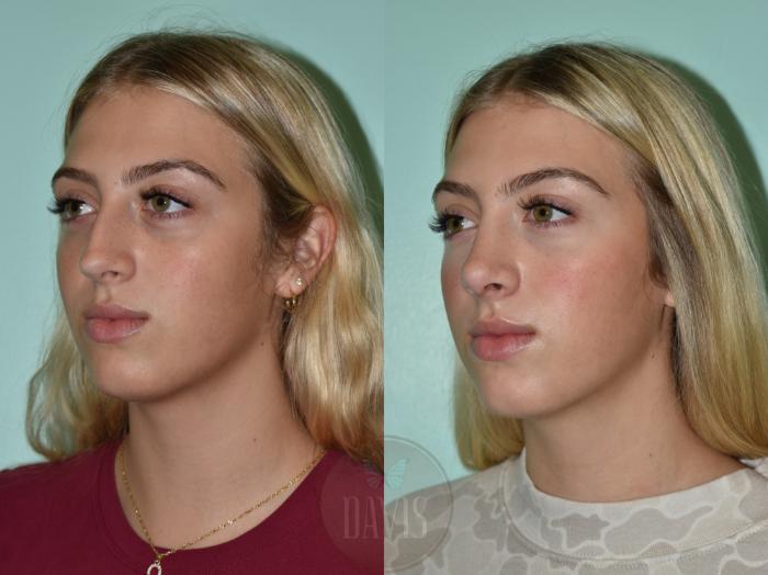 Before & After Female Rhinoplasty Case 1154 Left Oblique View in Tampa, FL