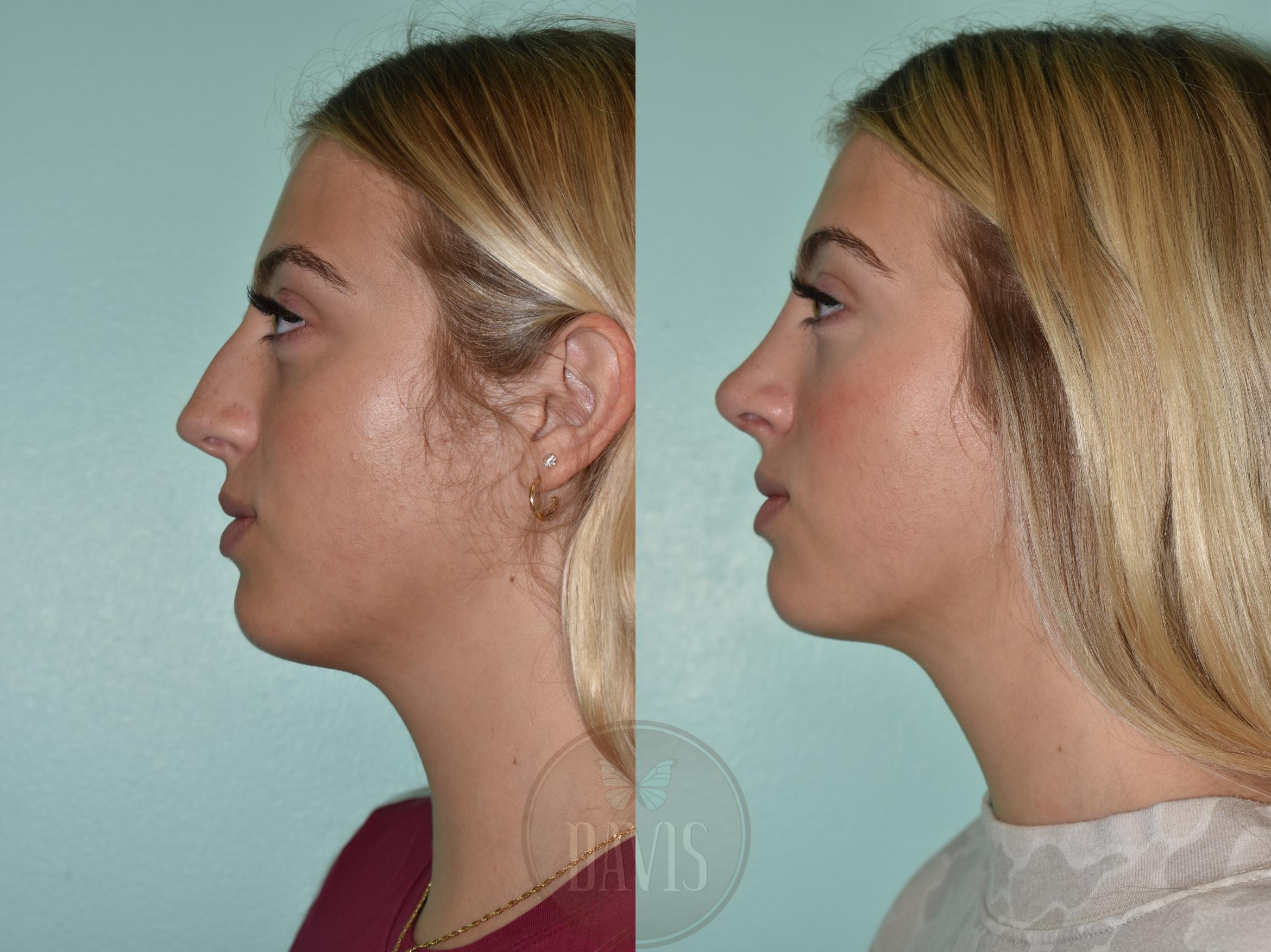 Before & After Female Rhinoplasty Case 1154 Left Side View in Tampa, FL