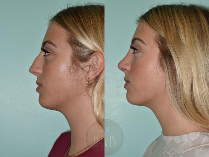 Before & After Female Rhinoplasty Case 1154 Left Side View in Tampa, FL
