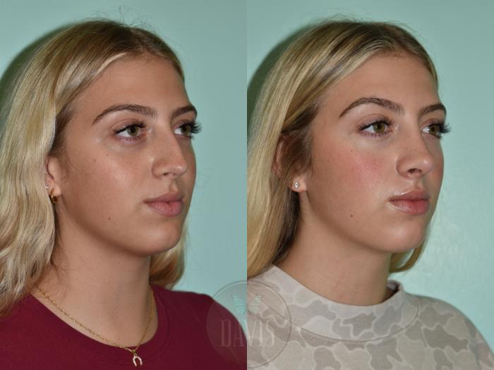 Before & After Female Rhinoplasty Case 1154 Right Oblique View in Tampa, FL