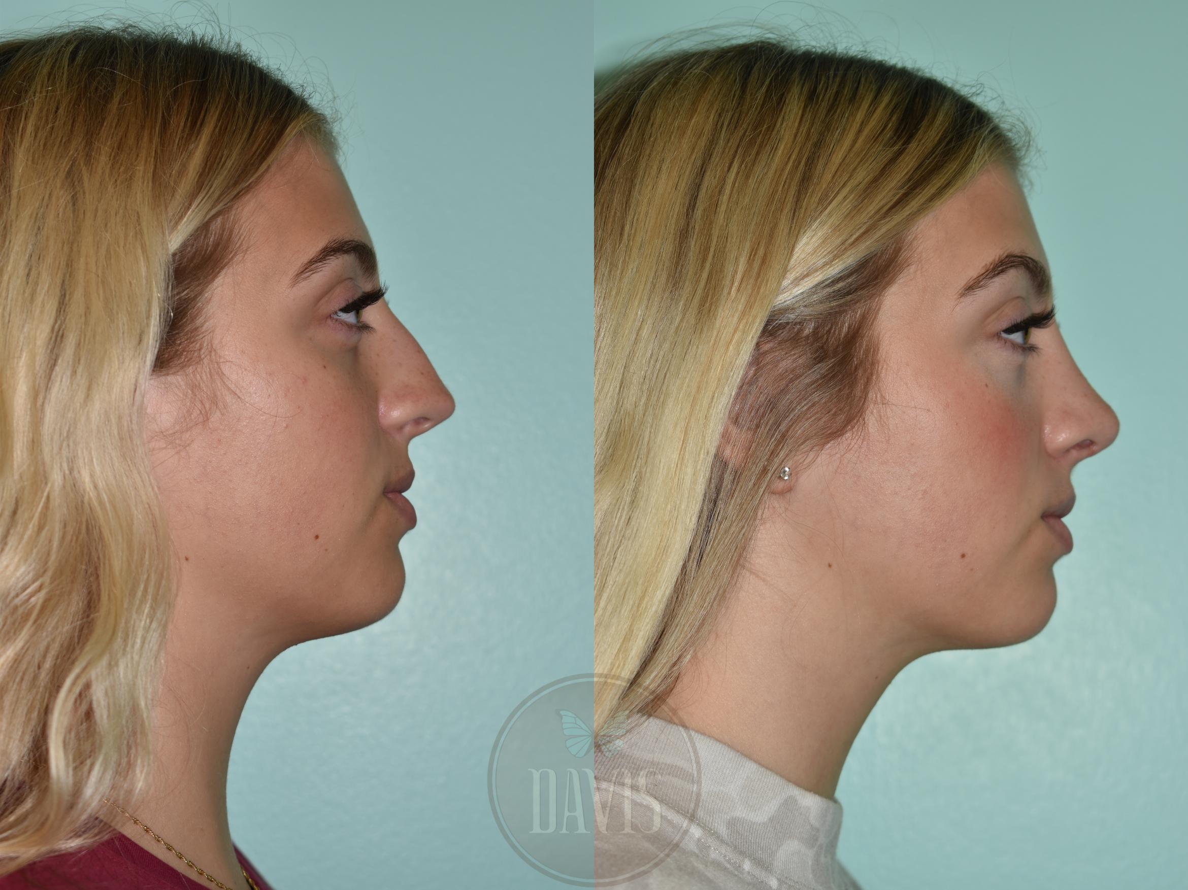 Before & After Female Rhinoplasty Case 1154 Right Side View in Tampa, FL
