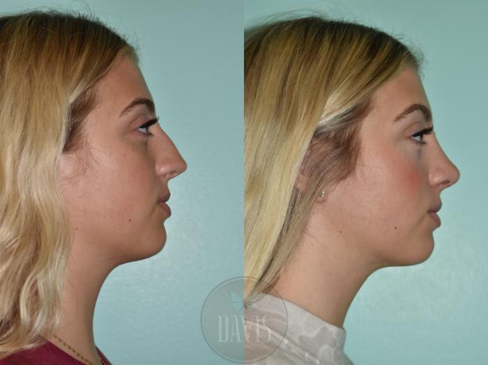Before & After Female Rhinoplasty Case 1154 Right Side View in Tampa, FL