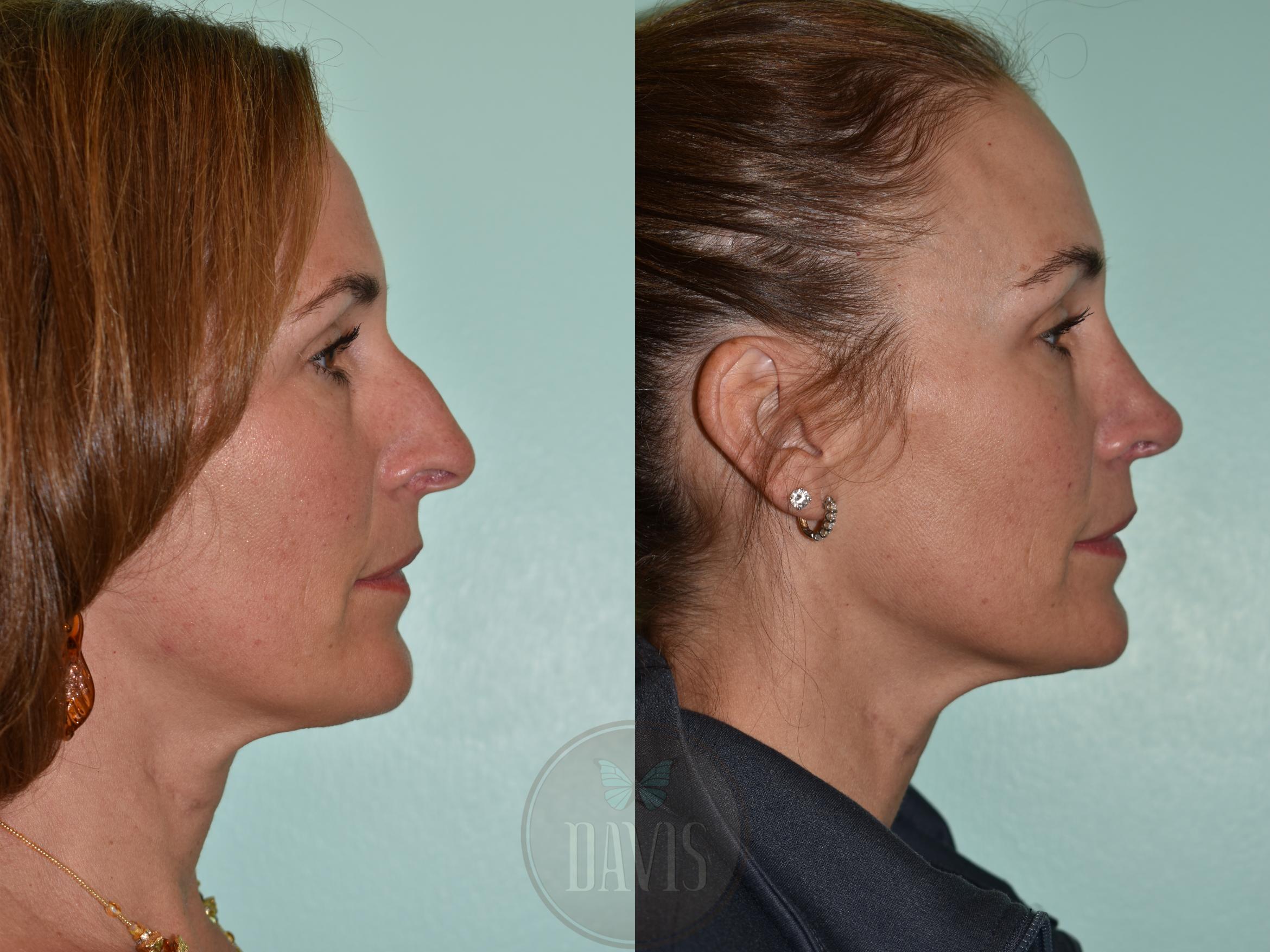 Before & After Female Rhinoplasty Case 1155 Front View in Tampa, FL