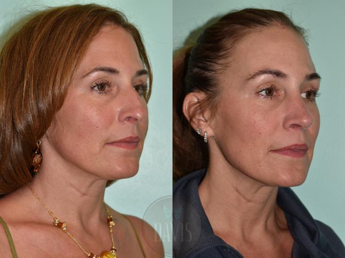 Before & After Female Rhinoplasty Case 1155 Left Oblique View in Tampa, FL