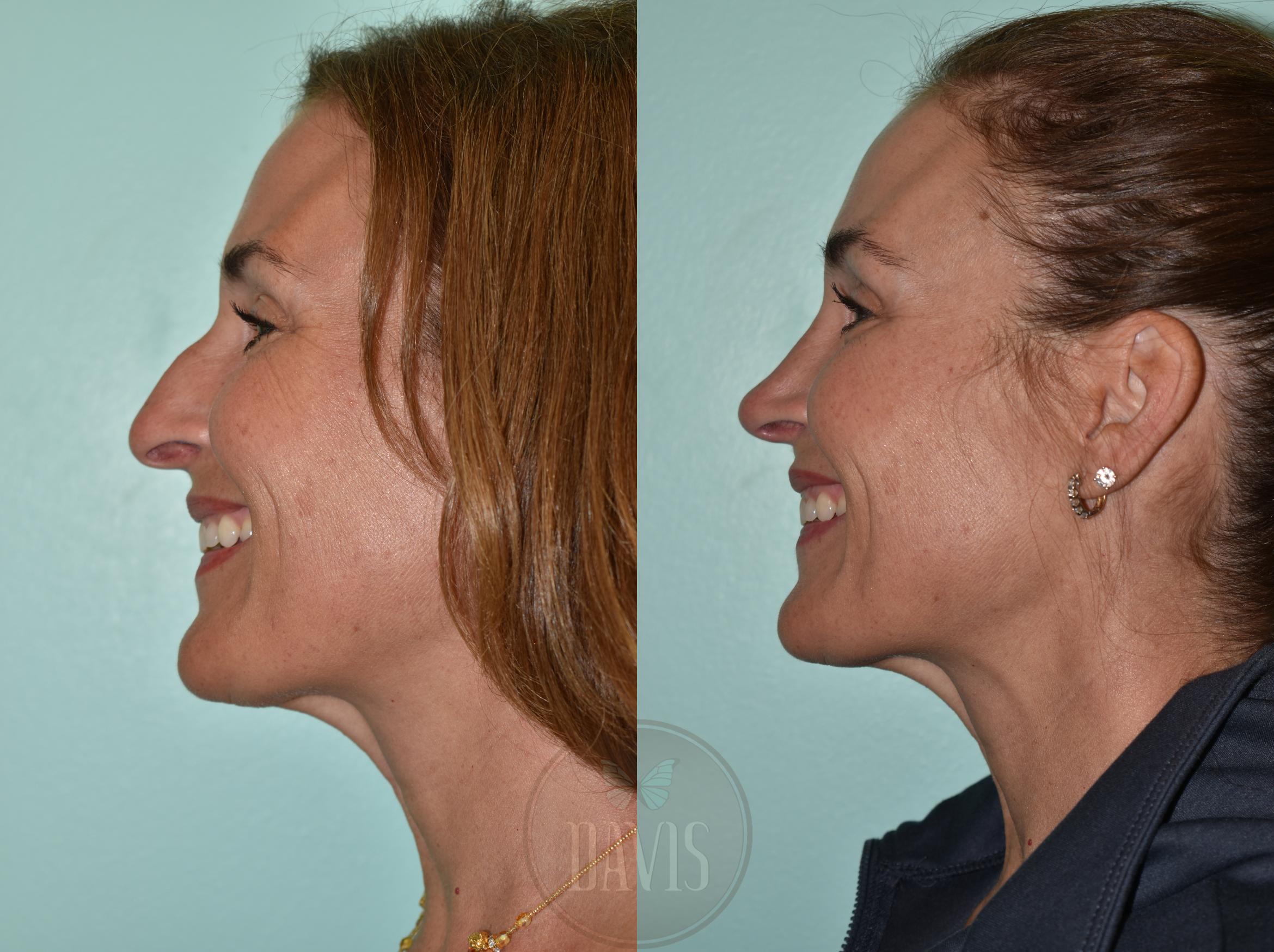 Before & After Female Rhinoplasty Case 1155 Left Side View in Tampa, FL